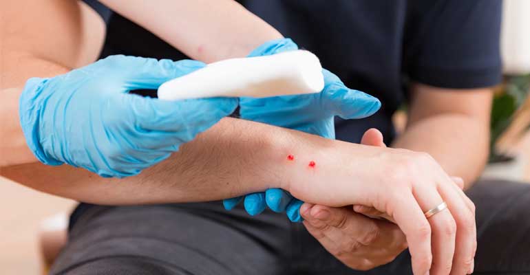 Snake Bite