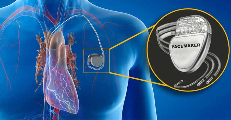 Pacemaker Implantation in kolhapur